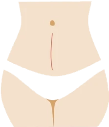 Vertical Cut for c section delivery
